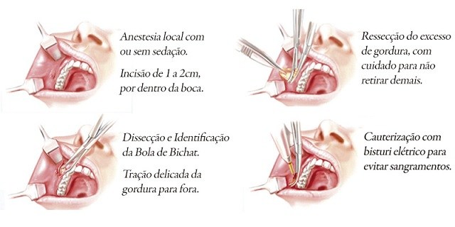 bichectomia-cirurgia-afina