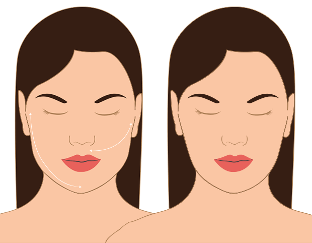 antes-depois-bichectomia