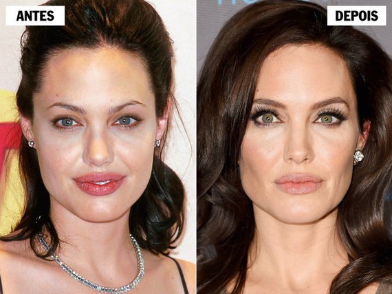 bichectomia-cirurgia-que-afina-o-rosto-vira-moda35-1-thumb-570